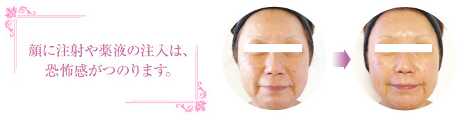 顔に注射や薬液の注入は、恐怖感がつのります。